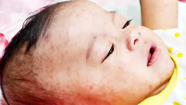 সারাদেশে ছড়িয়ে পড়েছে হামের প্রাদুর্ভাব