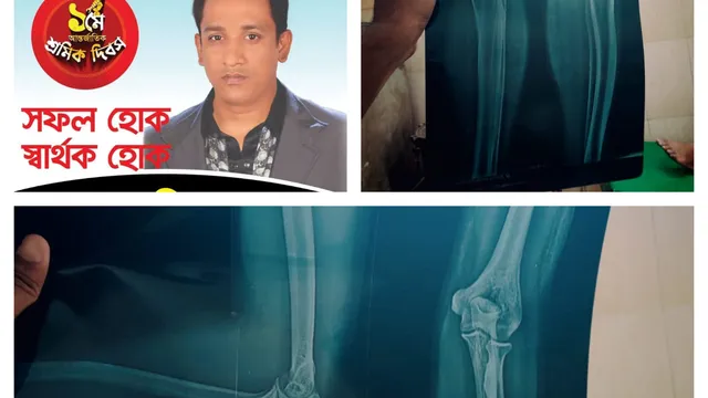 চাঁদা না পেয়ে ব্যবসায়ীর হাত-পা ভেঙে দিলেন শ্রমিকদল নেতা