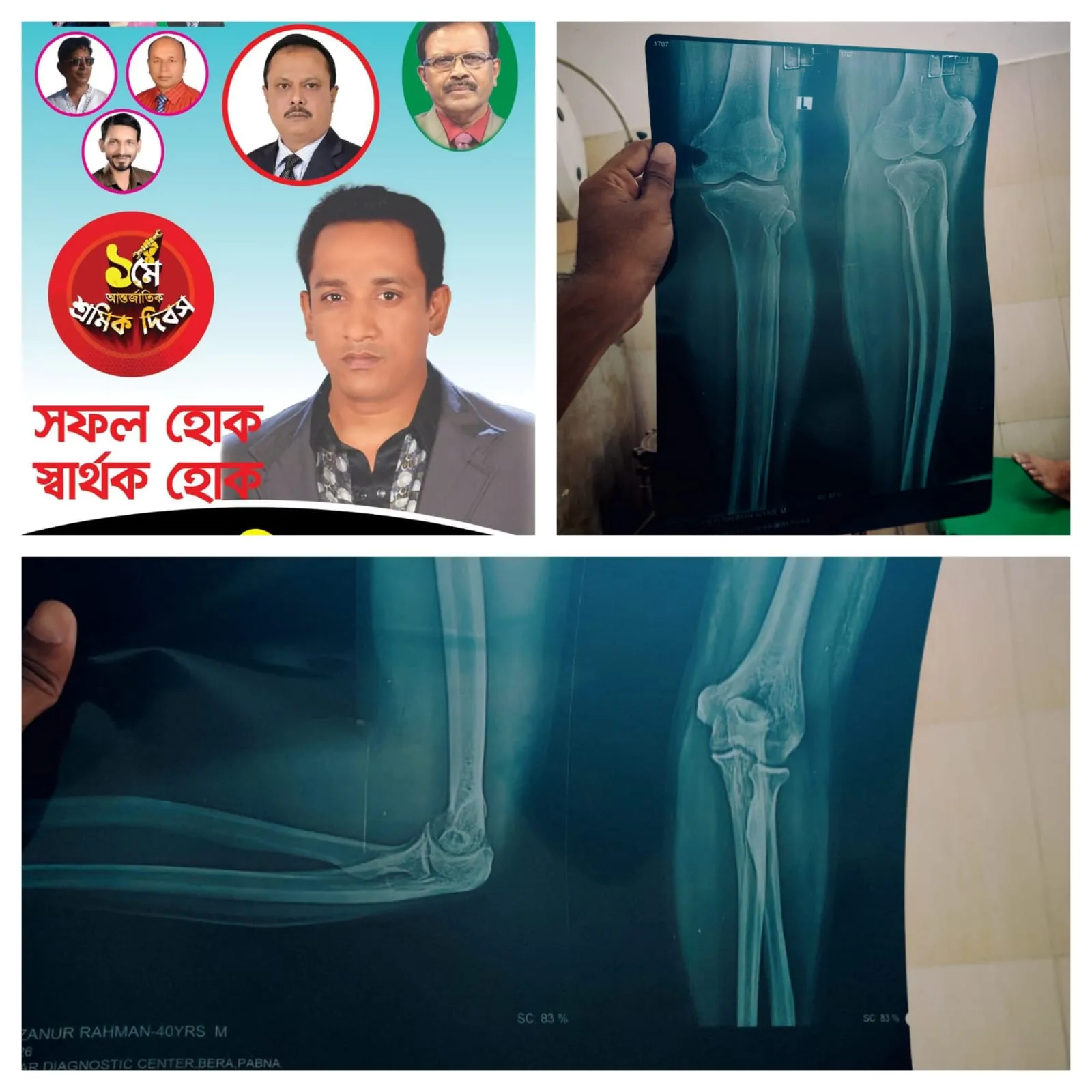 চাঁদা না পেয়ে ব্যবসায়ীর হাত-পা ভেঙে দিলেন শ্রমিকদল নেতা